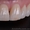 Лечение , протезирование и имплантация зубов в Полтаве на выгодных условиях - <ro>Изображение</ro><ru>Изображение</ru> #2, <ru>Объявление</ru> #1570533