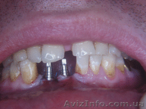 имплантация зубов - <ro>Изображение</ro><ru>Изображение</ru> #1, <ru>Объявление</ru> #30997