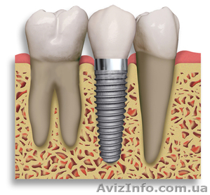 имплантация зубов в украине