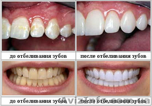 Безвредное отбеливание зубов - <ro>Изображение</ro><ru>Изображение</ru> #1, <ru>Объявление</ru> #804060