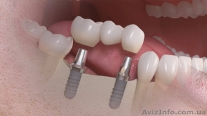 Лечение , протезирование и имплантация зубов в Полтаве на выгодных условиях - <ro>Изображение</ro><ru>Изображение</ru> #1, <ru>Объявление</ru> #1570533