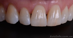 Лечение , протезирование и имплантация зубов в Полтаве на выгодных условиях - <ro>Изображение</ro><ru>Изображение</ru> #2, <ru>Объявление</ru> #1570533