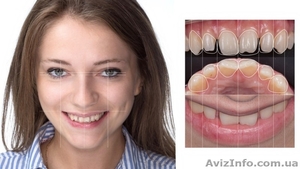 Лечение , протезирование и имплантация зубов в Полтаве на выгодных условиях - <ro>Изображение</ro><ru>Изображение</ru> #4, <ru>Объявление</ru> #1570533