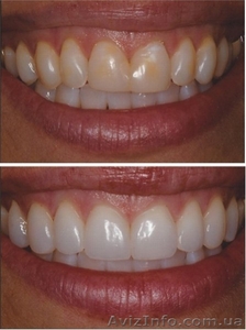 Лечение , протезирование и имплантация зубов в Полтаве на выгодных условиях - <ro>Изображение</ro><ru>Изображение</ru> #5, <ru>Объявление</ru> #1570533