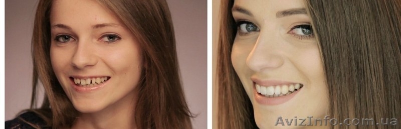 Лечение , протезирование и имплантация зубов в Полтаве на выгодных условиях - <ro>Изображение</ro><ru>Изображение</ru> #3, <ru>Объявление</ru> #1570533